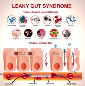 Leaky Gut Syndrome - Natura Med